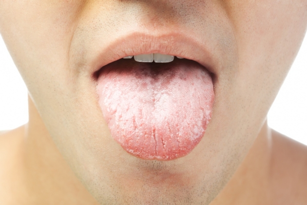 Que signifie la langue blanche ?